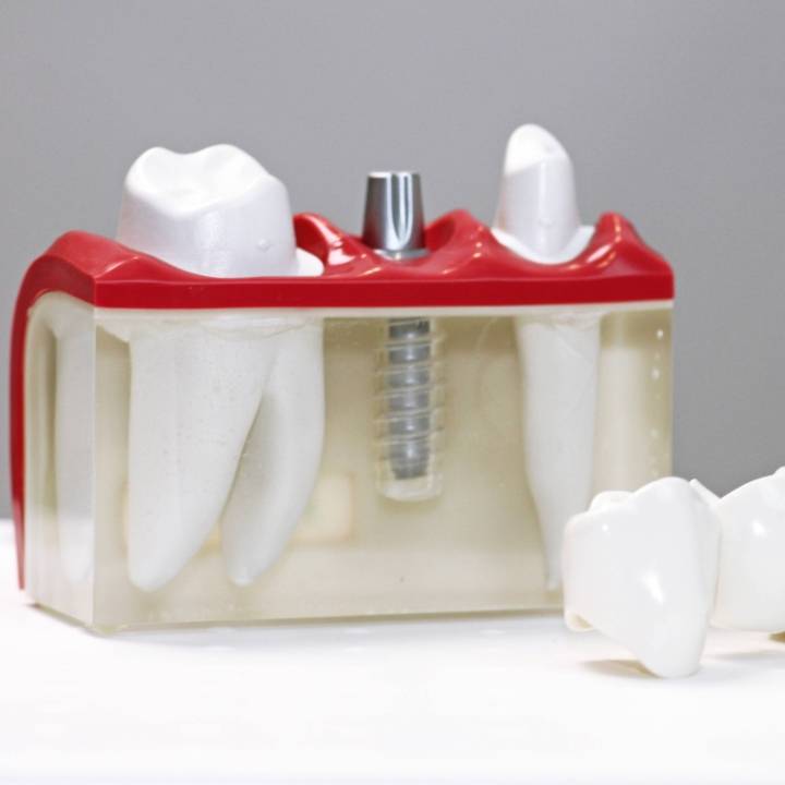 kroon bij de tandarts | bolwerk tandartsen maastricht | kroon bij de tandarts is niet pijnlijk