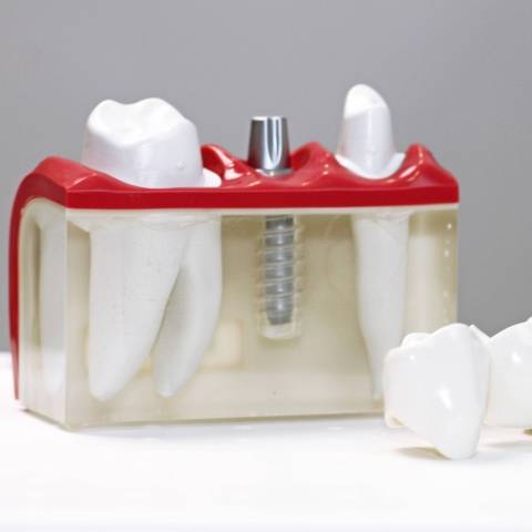 implantaat plaatsen | wat is een implantaat | bolwerk tandartsen maastricht