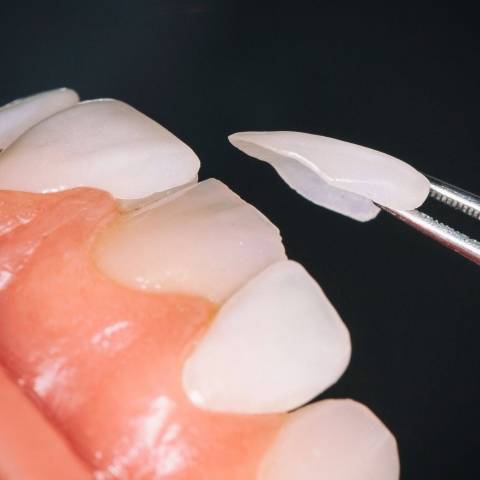 Cosmetische tandheelkunde | mooie tanden maastricht | facings bij de tandarts